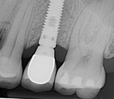 Dental İmplant Hizmeti